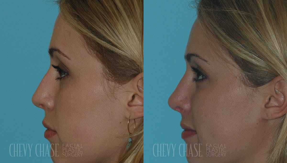 Revision Rhinoplasty Before & After Gallery - Patient 106387405 - Image 1