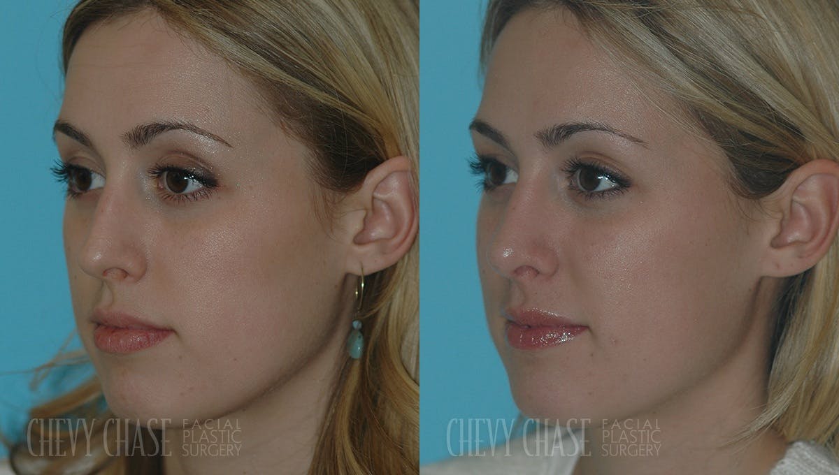 Revision Rhinoplasty Before & After Gallery - Patient 106387405 - Image 2