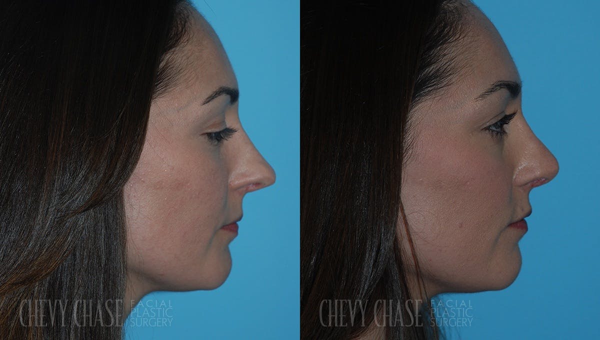 Revision Rhinoplasty Before & After Gallery - Patient 106387407 - Image 1