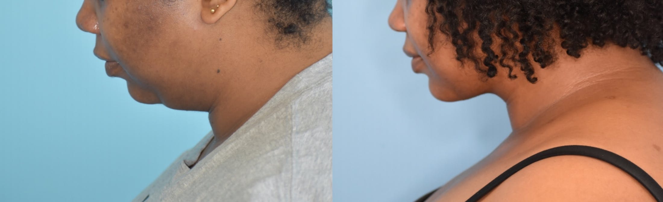 Facelift And Necklift Before & After Gallery - Patient 106387418 - Image 8