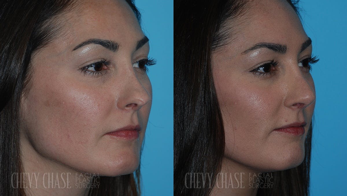Revision Rhinoplasty Before & After Gallery - Patient 106387407 - Image 2