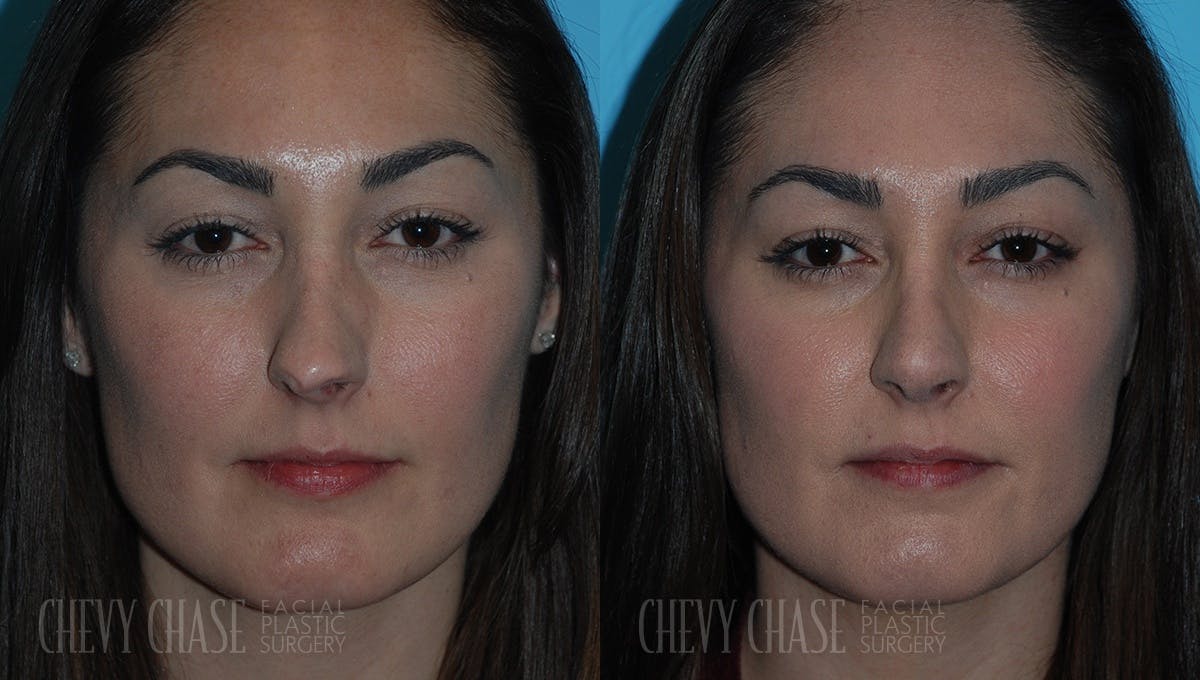 Revision Rhinoplasty Before & After Gallery - Patient 106387407 - Image 3