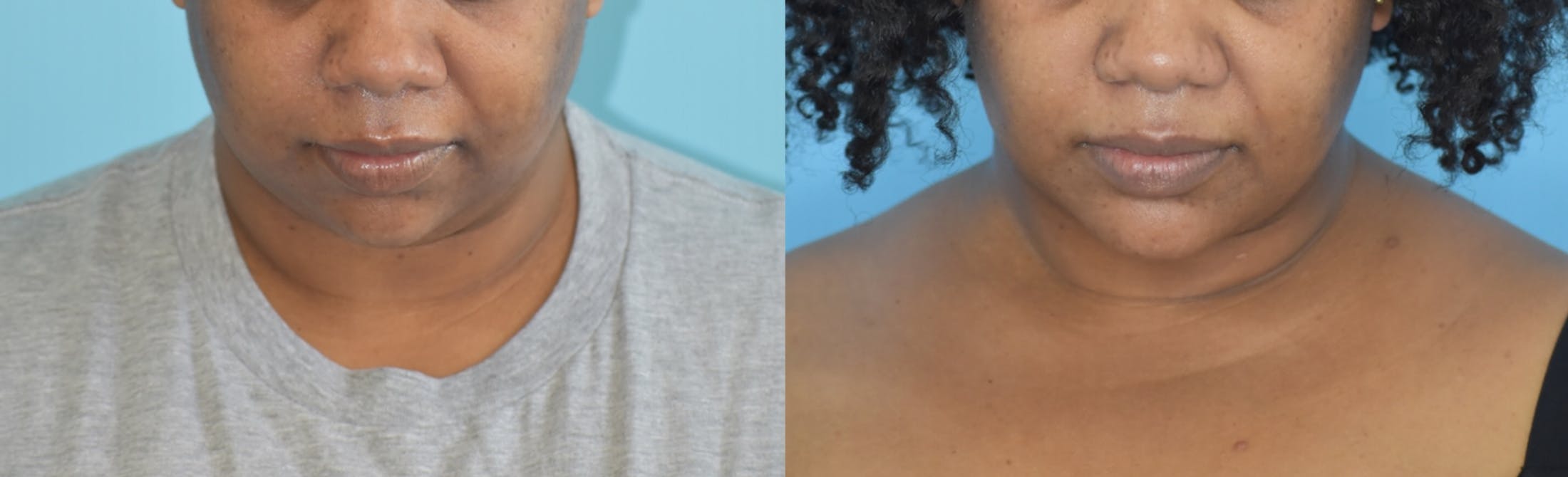 Facelift And Necklift Before & After Gallery - Patient 106387418 - Image 2