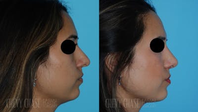 Revision Rhinoplasty Before & After Gallery - Patient 106387419 - Image 1