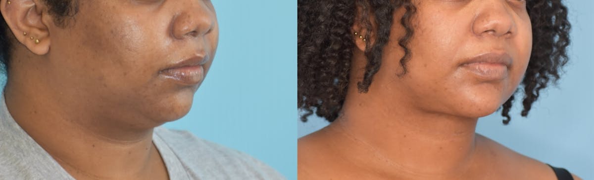 Facelift And Necklift Before & After Gallery - Patient 106387418 - Image 4