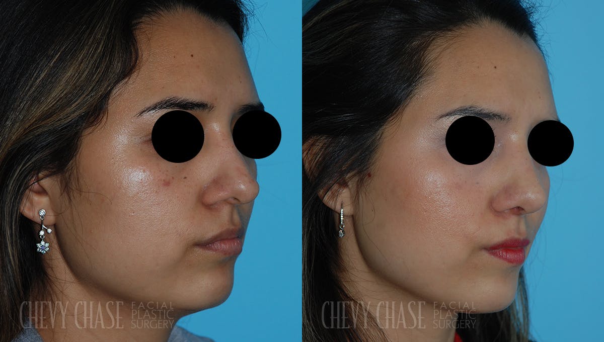Revision Rhinoplasty Before & After Gallery - Patient 106387419 - Image 2