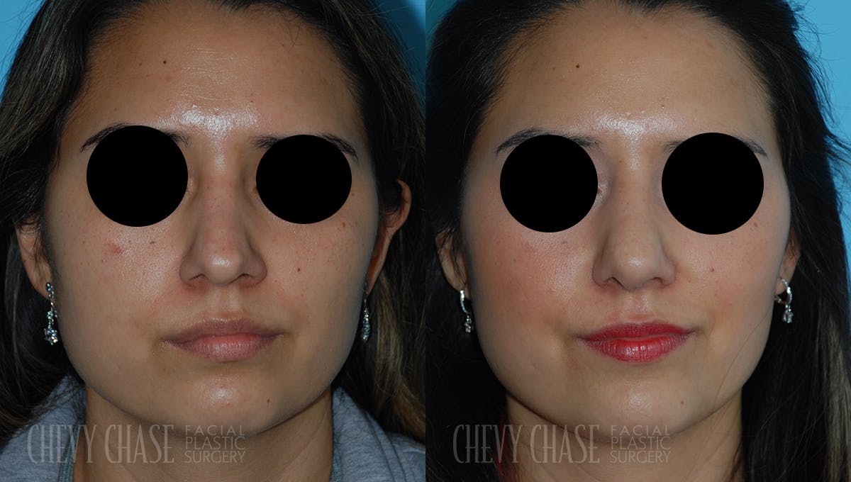 Revision Rhinoplasty Before & After Gallery - Patient 106387419 - Image 3