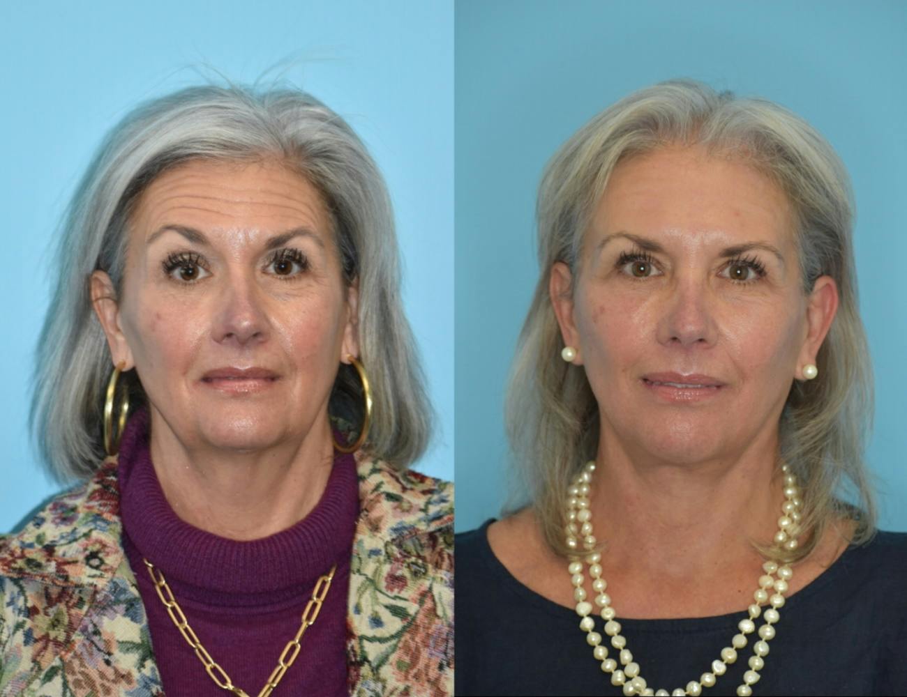 Facelift And Necklift Before & After Gallery - Patient 106387423 - Image 1