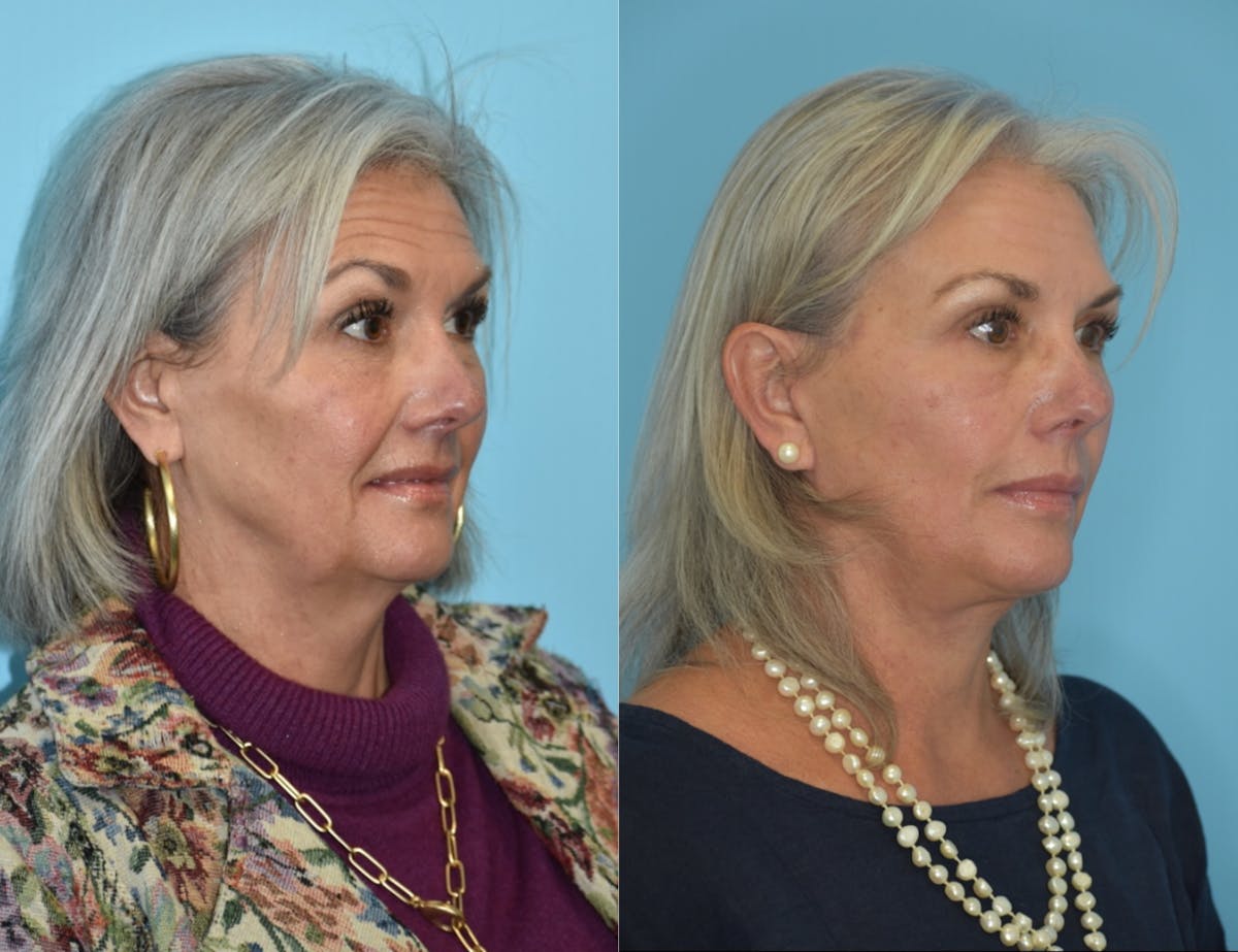 Facelift And Necklift Before & After Gallery - Patient 106387423 - Image 2
