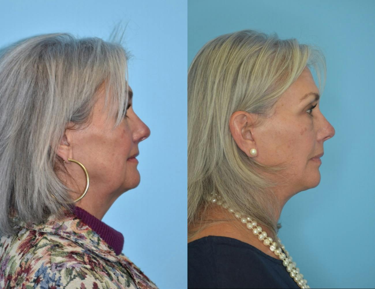Facelift And Necklift Before & After Gallery - Patient 106387423 - Image 3