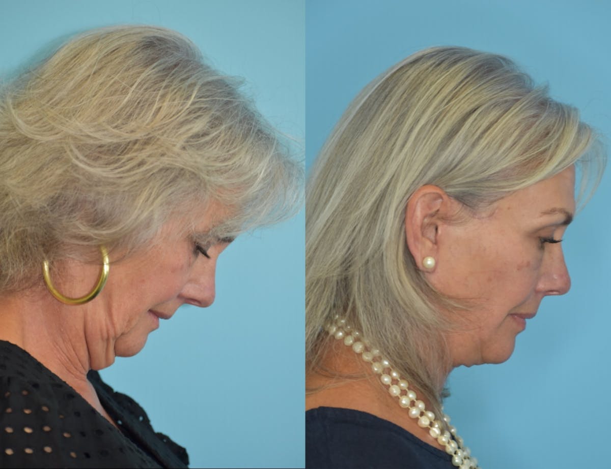 Facelift And Necklift Before & After Gallery - Patient 106387423 - Image 4