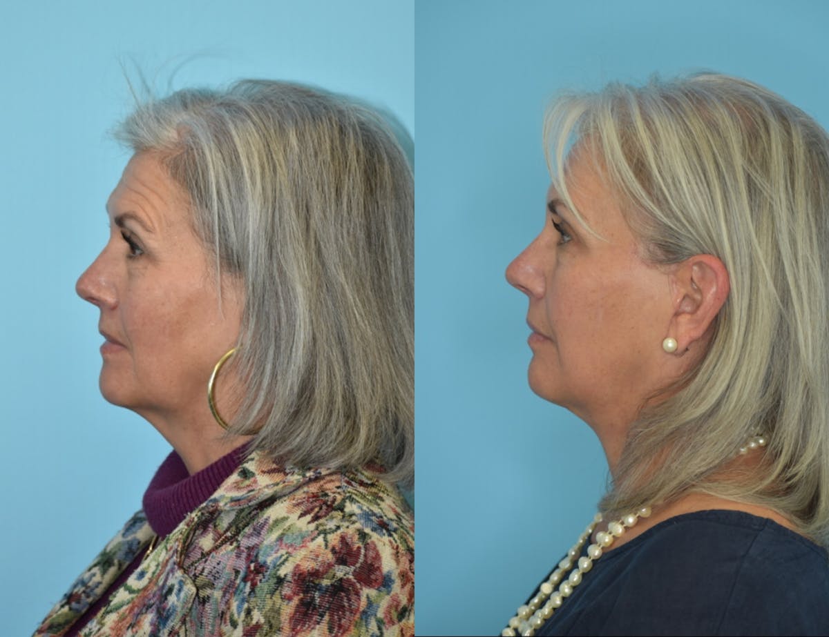 Facelift And Necklift Before & After Gallery - Patient 106387423 - Image 5