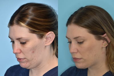 Facelift And Necklift Before & After Gallery - Patient 106387428 - Image 1