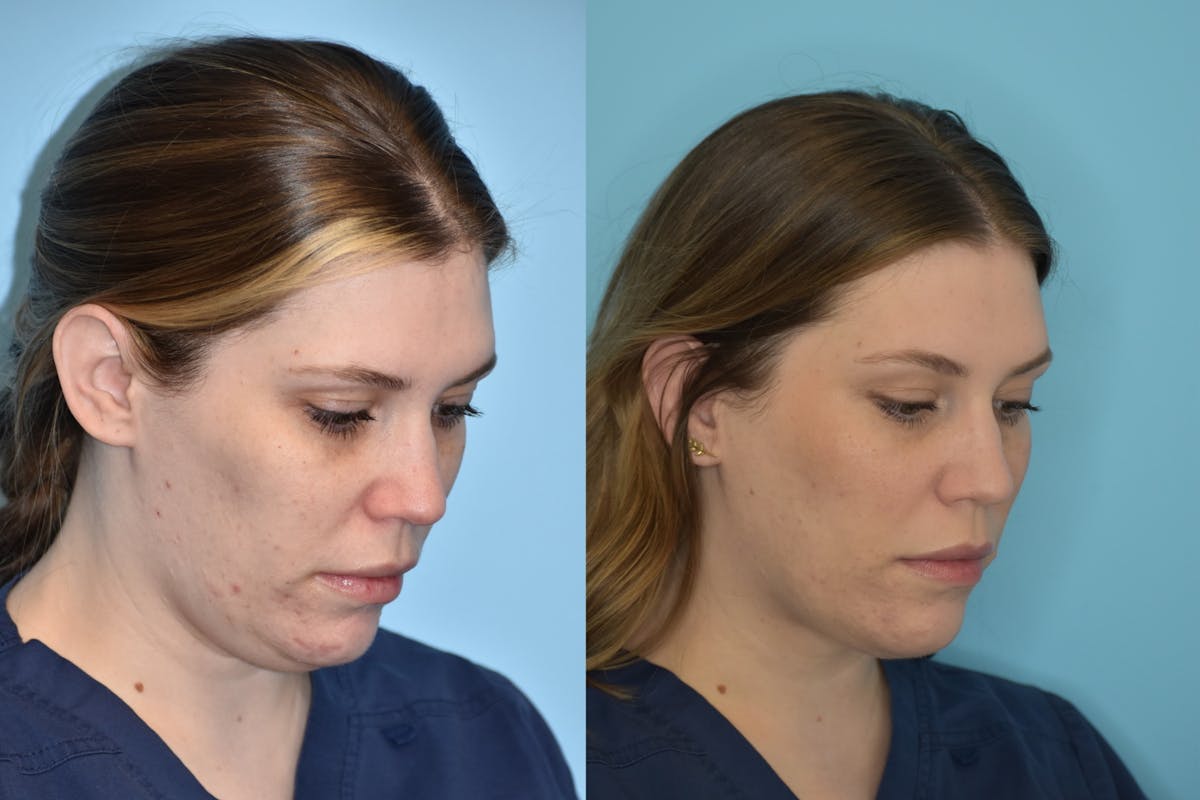 Facelift And Necklift Before & After Gallery - Patient 106387428 - Image 2