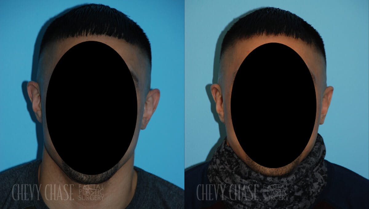 Otoplasty/Earlobe Repair Before & After Gallery - Patient 106387424 - Image 2