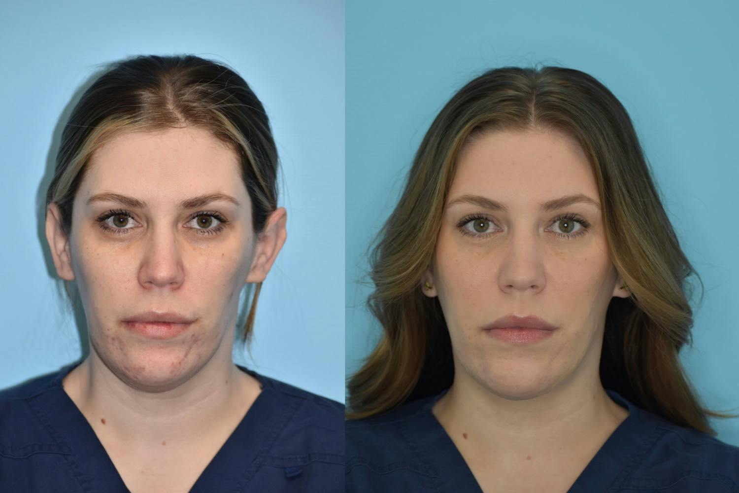 Facelift And Necklift Before & After Gallery - Patient 106387428 - Image 3