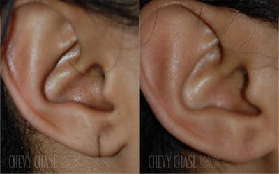 Otoplasty/Earlobe Repair Before & After Gallery - Patient 106387425 - Image 1