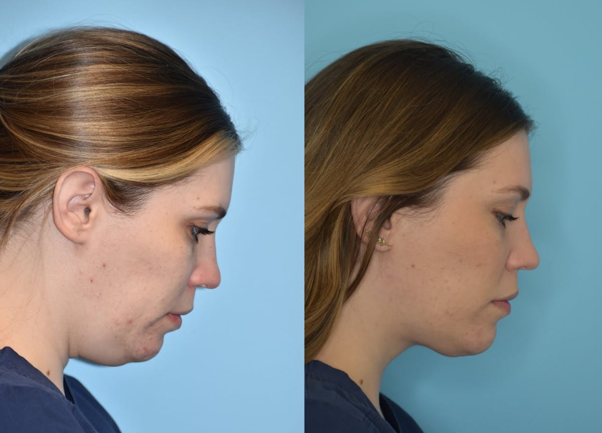 Facelift And Necklift Before & After Gallery - Patient 106387428 - Image 4