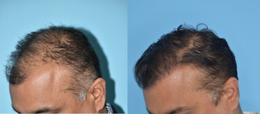 Hair Transplantation Before & After Gallery - Patient 106387430 - Image 1