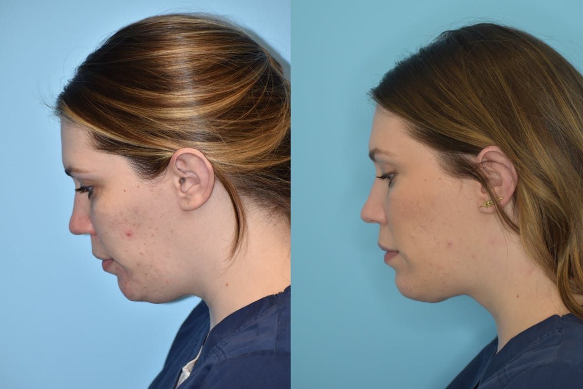 Facelift And Necklift Before & After Gallery - Patient 106387428 - Image 5