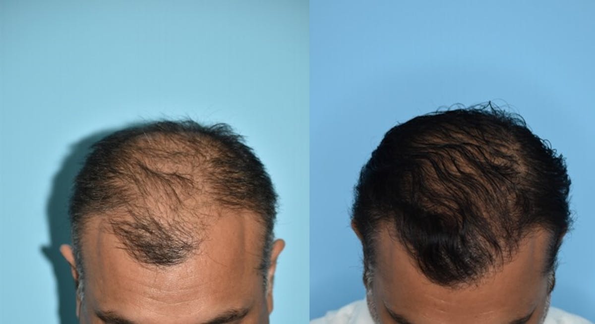 Hair Transplantation Before & After Gallery - Patient 106387430 - Image 2