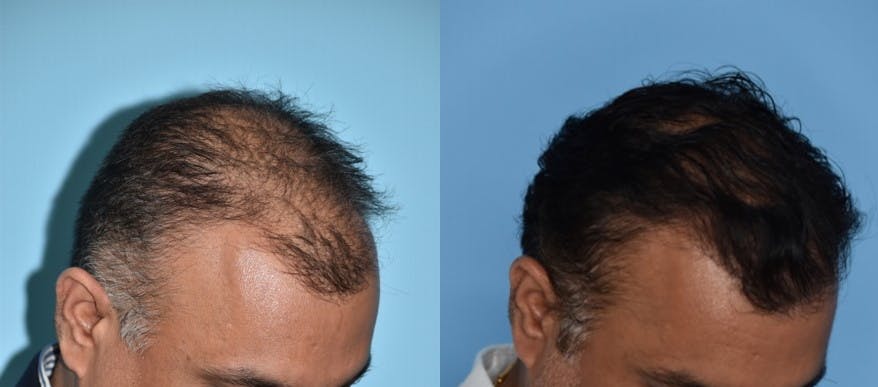 Hair Transplantation Before & After Gallery - Patient 106387430 - Image 3