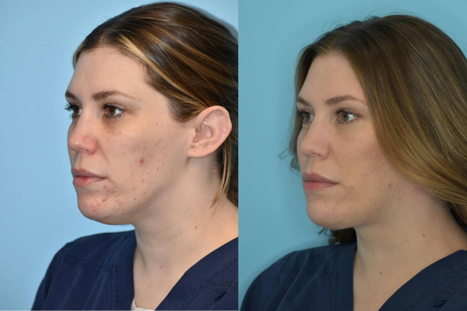 Facelift And Necklift Before & After Gallery - Patient 106387428 - Image 6