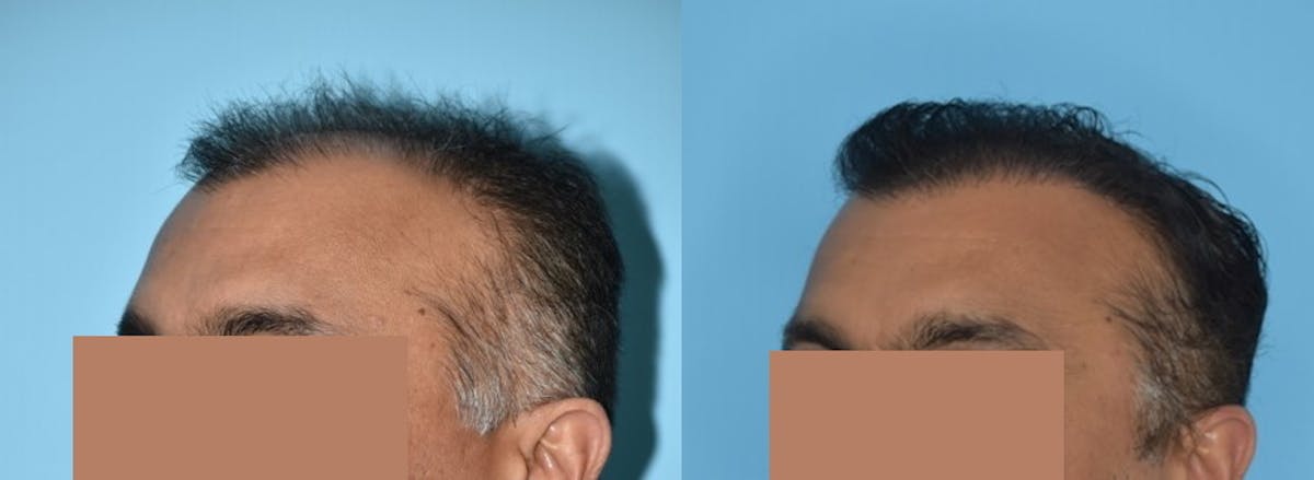 Hair Transplantation Before & After Gallery - Patient 106387430 - Image 4