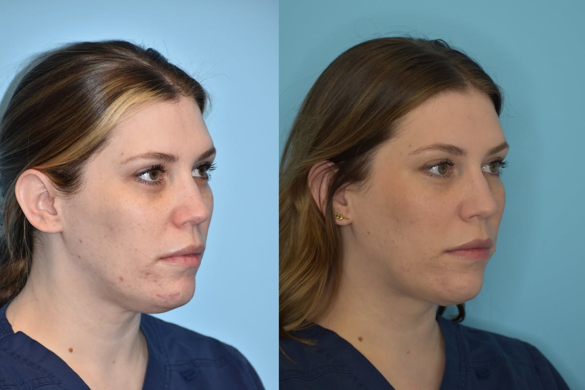 Facelift And Necklift Before & After Gallery - Patient 106387428 - Image 7