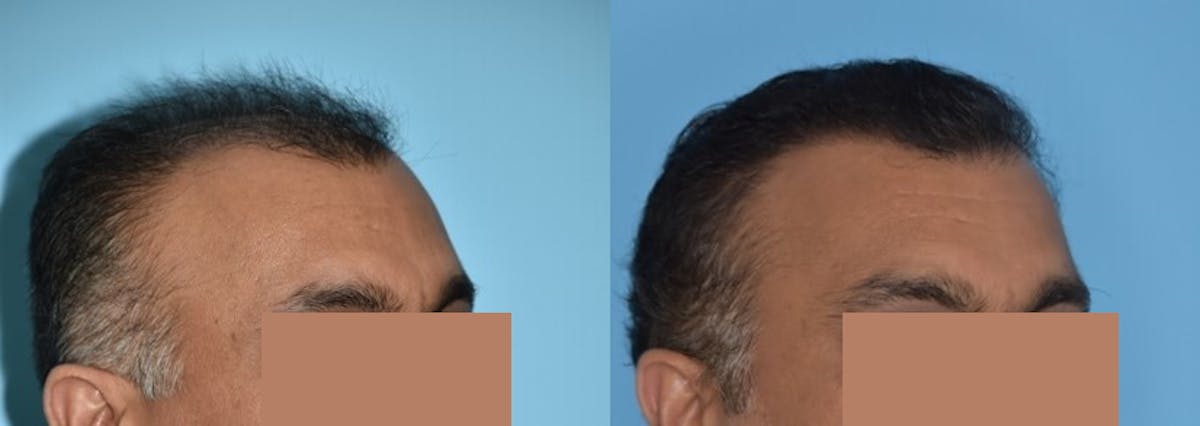 Hair Transplantation Before & After Gallery - Patient 106387430 - Image 5