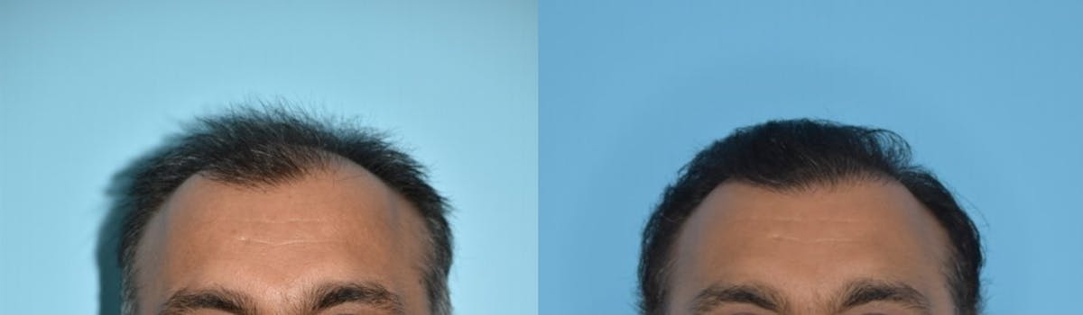 Hair Transplantation Before & After Gallery - Patient 106387430 - Image 6