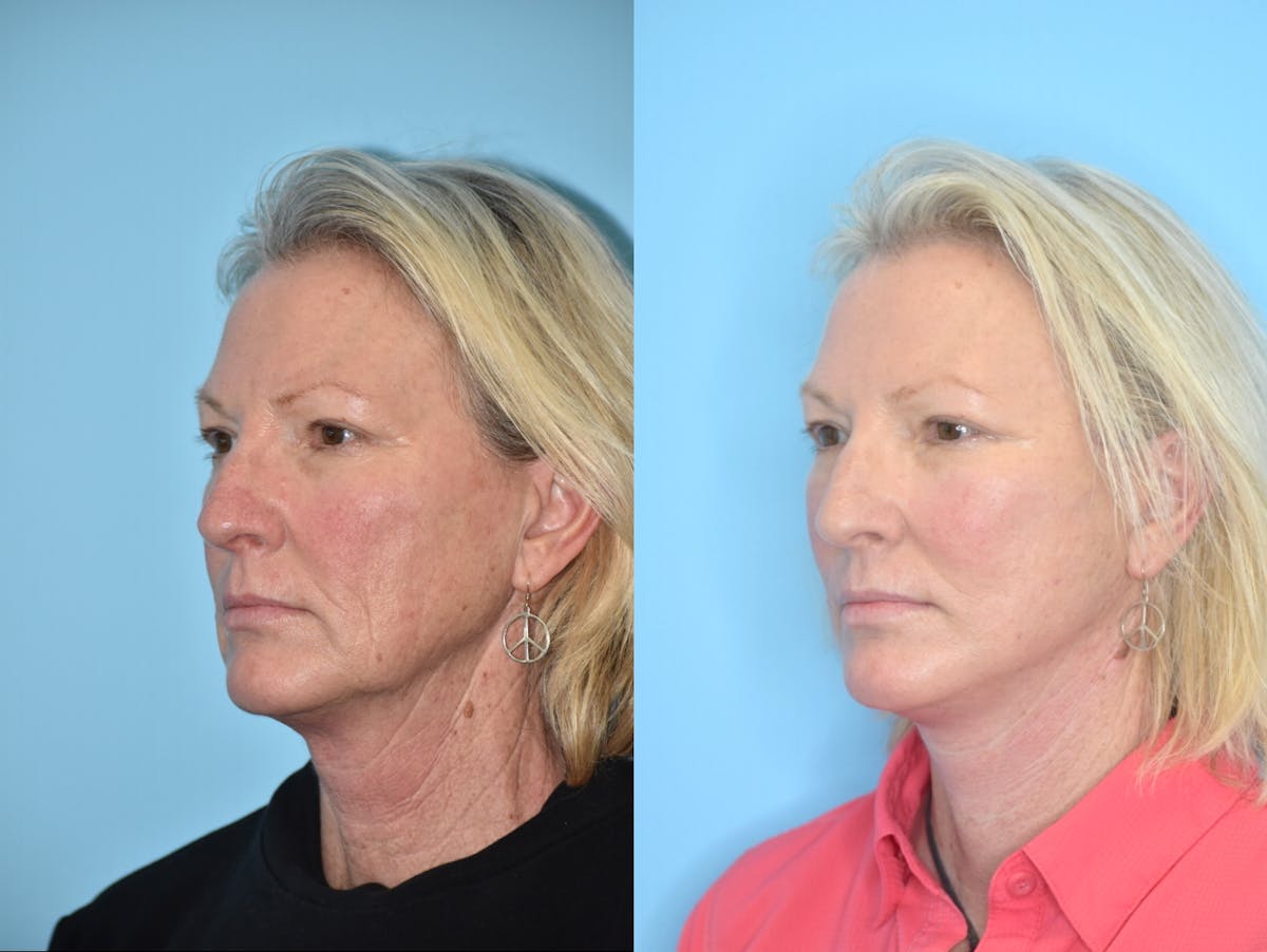 Facelift And Necklift Before & After Gallery - Patient 106387432 - Image 1