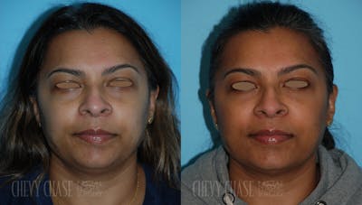 Botox® / Wrinkle Treatments Before & After Gallery - Patient 106387431 - Image 1