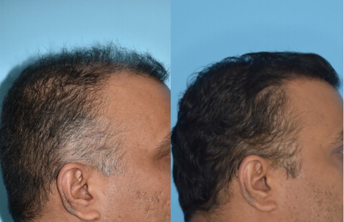 Hair Transplantation Before & After Gallery - Patient 106387430 - Image 7