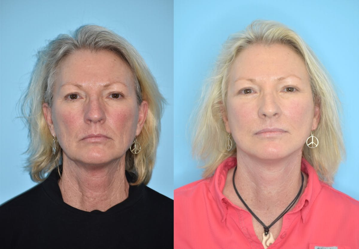 Facelift And Necklift Before & After Gallery - Patient 106387432 - Image 2
