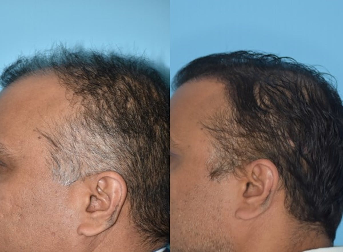 Hair Transplantation Before & After Gallery - Patient 106387430 - Image 8