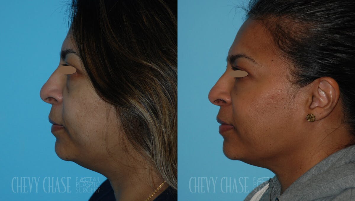 Botox® / Wrinkle Treatments Before & After Gallery - Patient 106387431 - Image 2