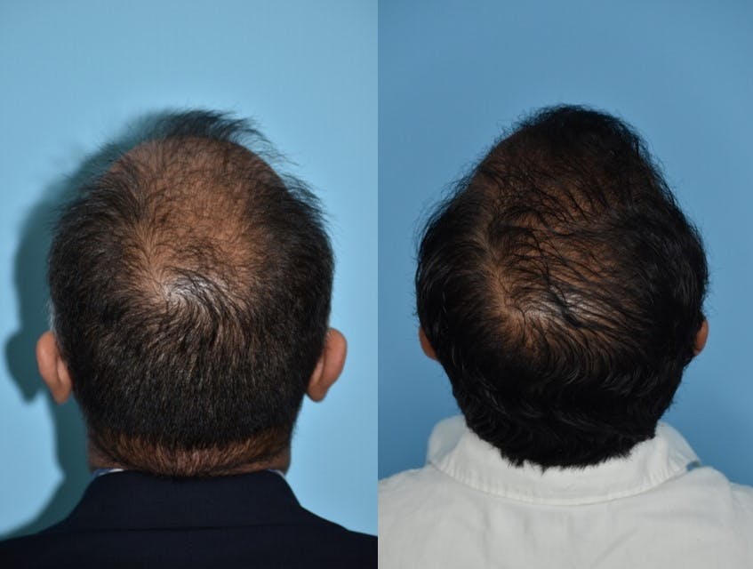 Hair Transplantation Before & After Gallery - Patient 106387430 - Image 9