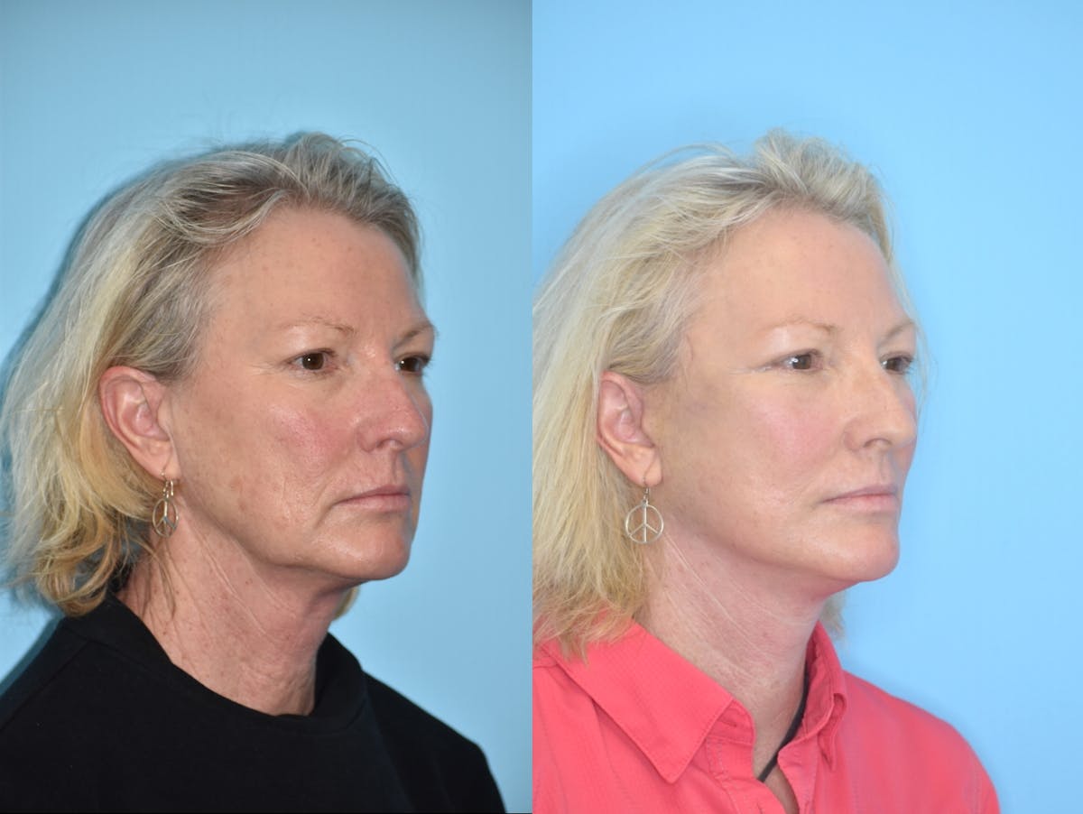 Facelift And Necklift Before & After Gallery - Patient 106387432 - Image 3
