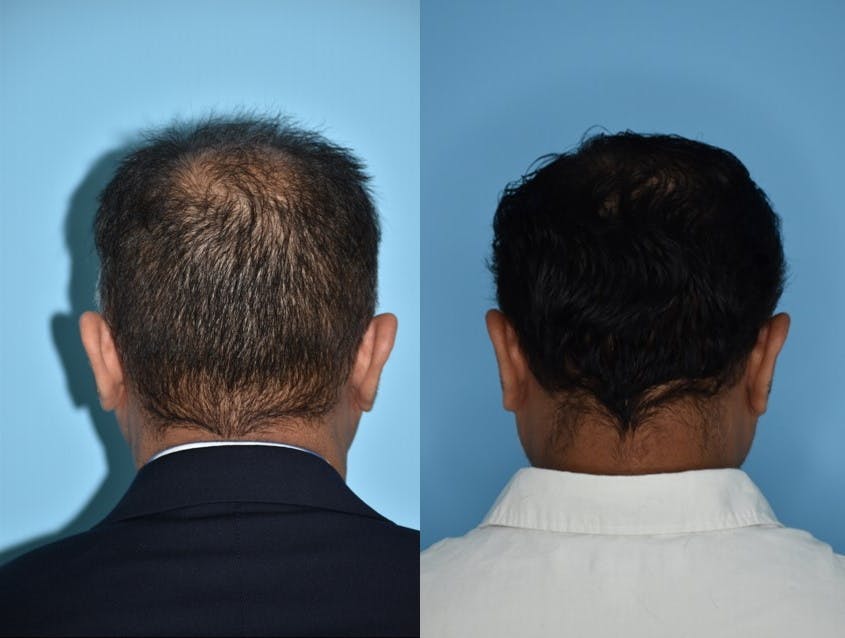 Hair Transplantation Before & After Gallery - Patient 106387430 - Image 10