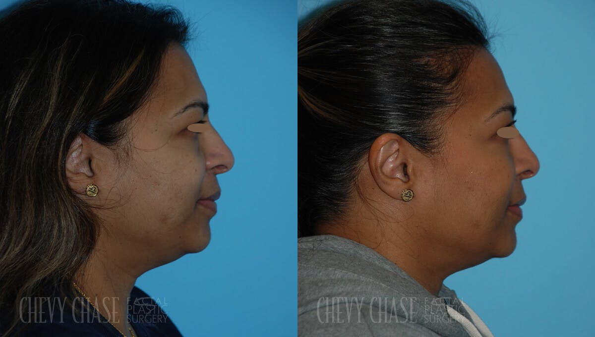 Botox® / Wrinkle Treatments Before & After Gallery - Patient 106387431 - Image 4
