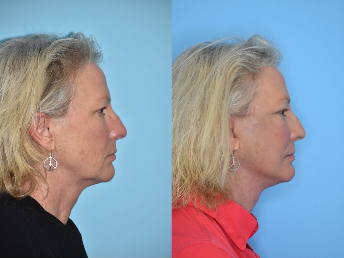 Facelift And Necklift Before & After Gallery - Patient 106387432 - Image 4