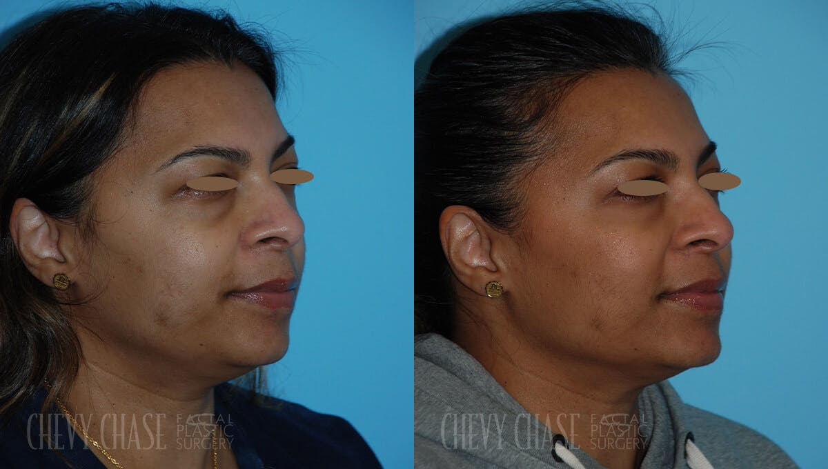 Botox® / Wrinkle Treatments Before & After Gallery - Patient 106387431 - Image 5