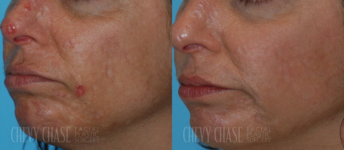 Acne Scars Before & After Gallery - Patient 106387434 - Image 1