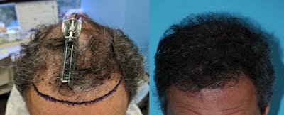 Hair Transplantation Before & After Gallery - Patient 106387441 - Image 1