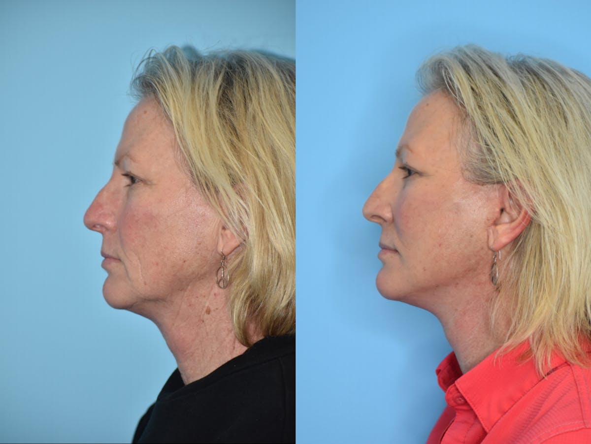 Facelift And Necklift Before & After Gallery - Patient 106387432 - Image 5