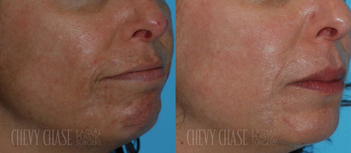 Acne Scars Before & After Gallery - Patient 106387434 - Image 2