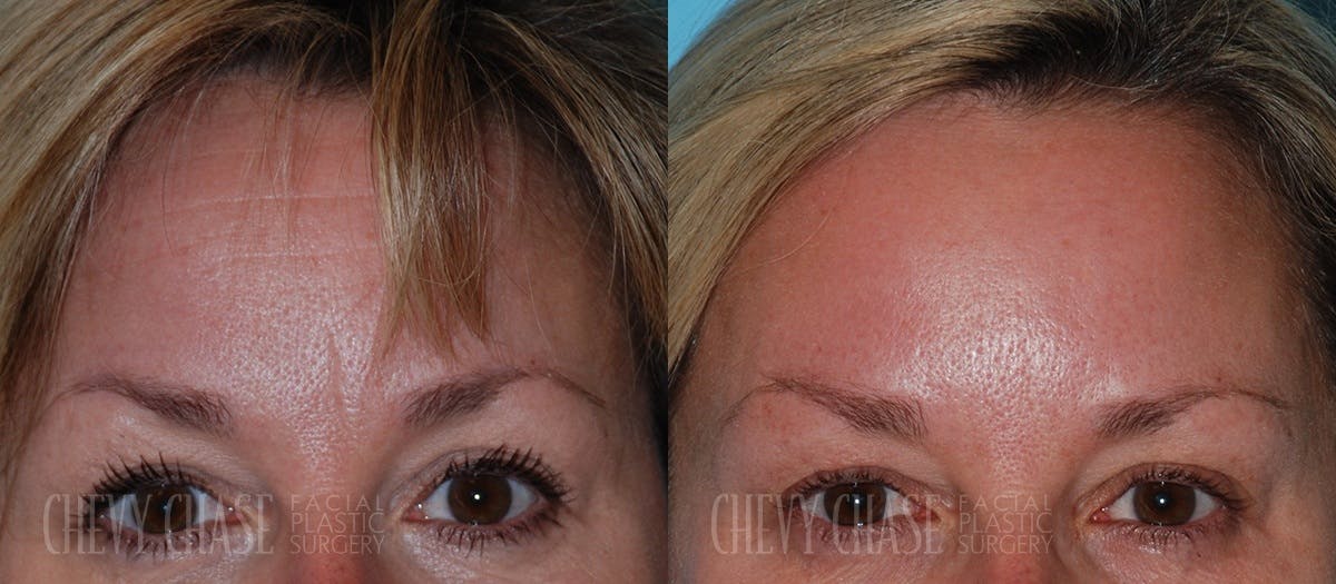 Botox® / Wrinkle Treatments Before & After Gallery - Patient 106387433 - Image 1