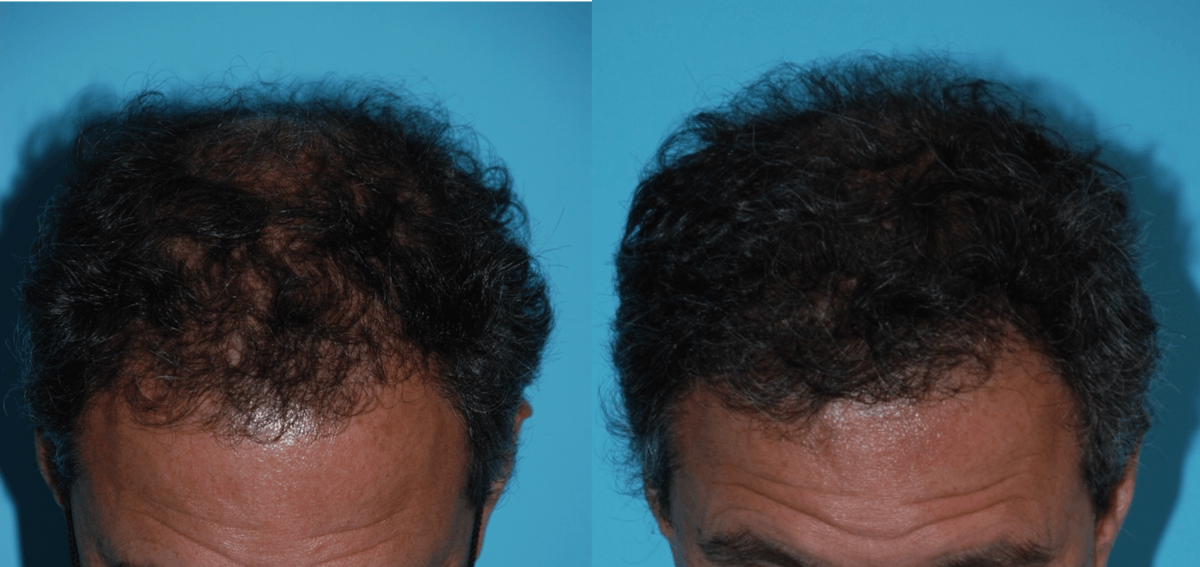 Hair Transplantation Before & After Gallery - Patient 106387441 - Image 2