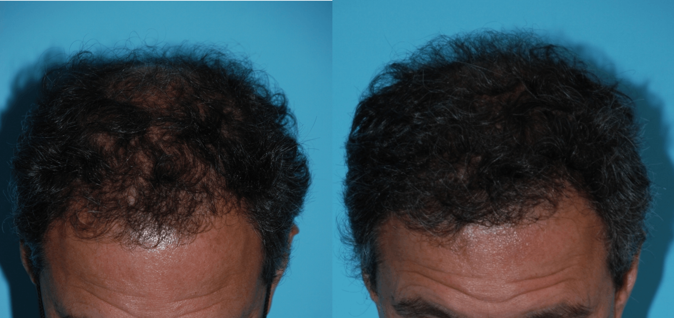 Hair Transplantation Before & After Gallery - Patient 106387441 - Image 2